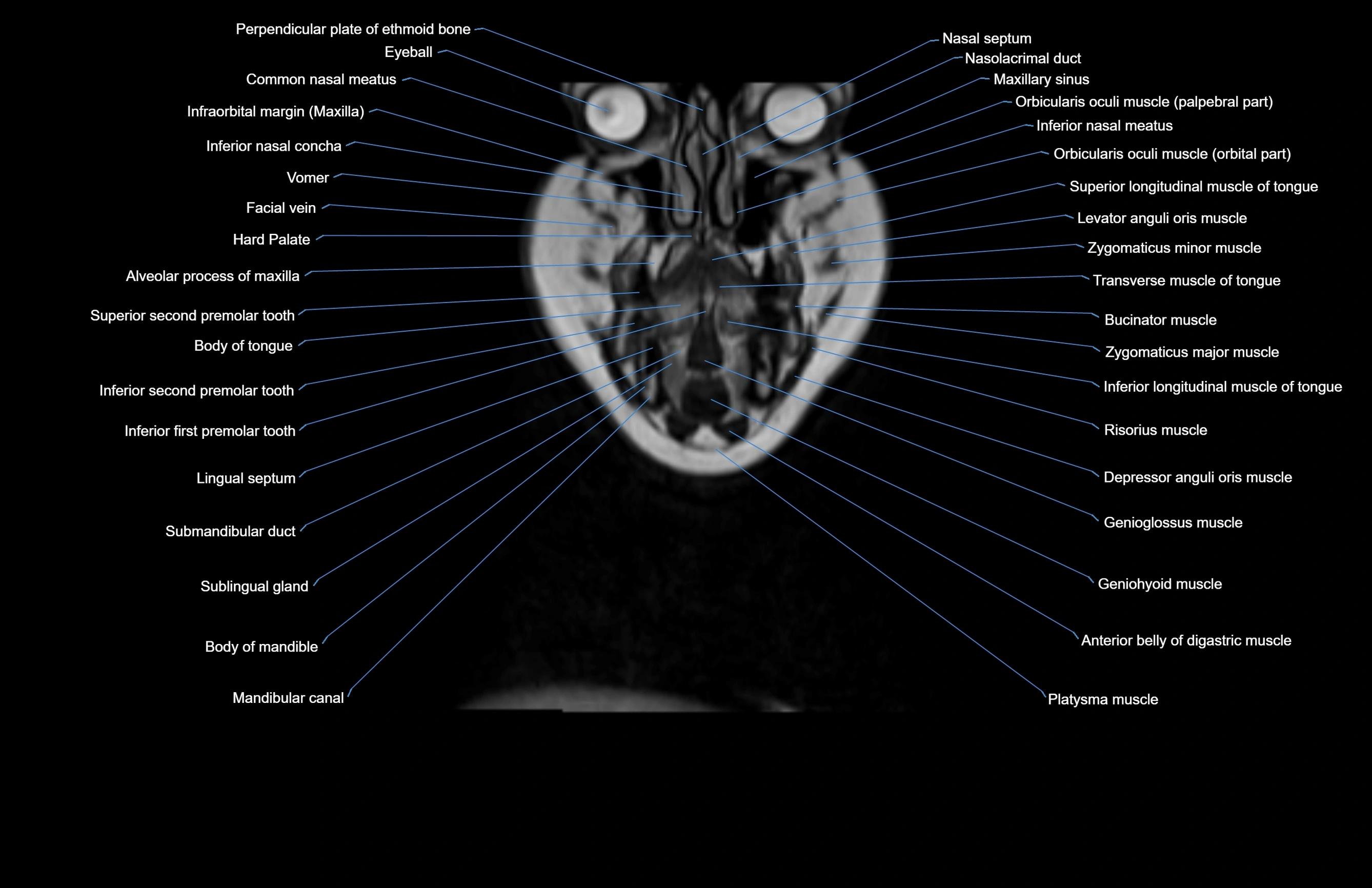 Neck coronal cross sectional MRI anatomy 3T MRI  image-img-00001-00068.webp